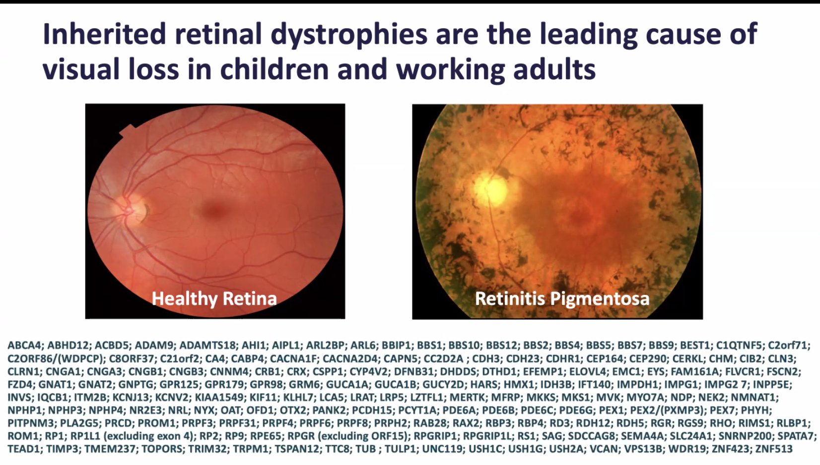 2nd Webinar - Sight Loss Research in Ciliopathies - Monday 3rd June 2024 Image of healthy retina and one with retinitis pigmentosa